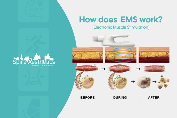 EMS treatment for post pregnancy weight loss treatment Billericay