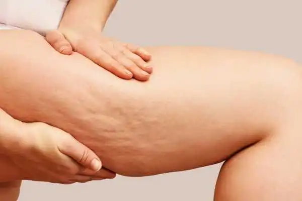 Image of woman showing leg with cellulite Billericay