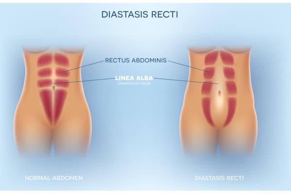 What Non-Surgical Options Are Available for Diastasis Recti Billericay?