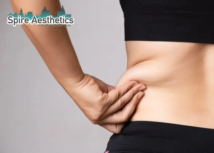Image of woman pinching fat on their hips Billericay. Fat Freezing treatment