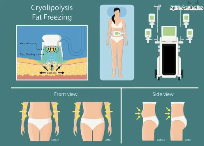Fat freezing treatment Billericay benefits for competitions to remove stubborn fat deposits.