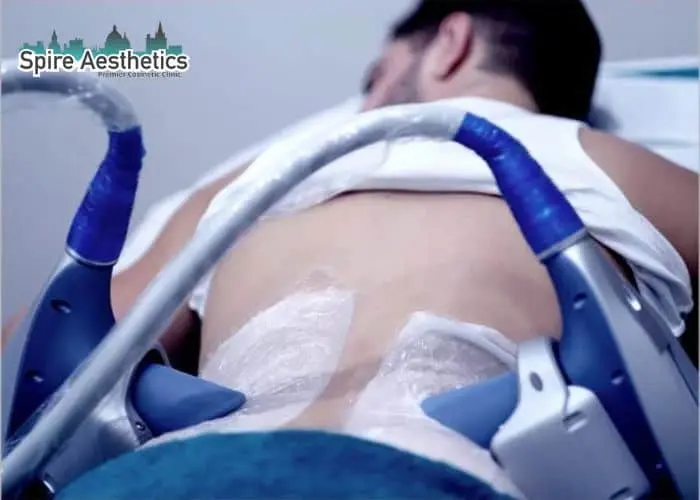 Man having fat freezing treatment done on love handles before a competitions Billericay to create a sculpted look.