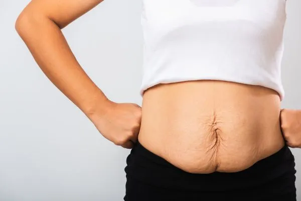 Image of a woman's stomach after weight loss with sagging skin following a gastric band Billericay
