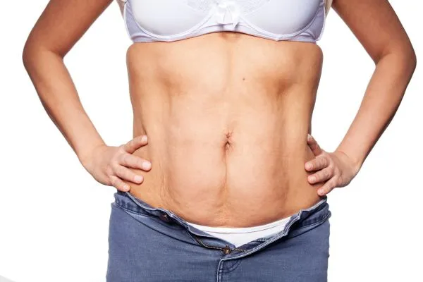 sagging skin on woman's stomach after weight loss injections Billericay