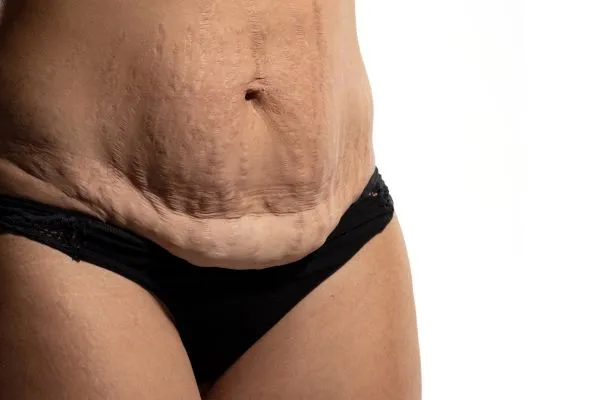 Image of womans stomach after weight loss injections Billericay showing saggy skin