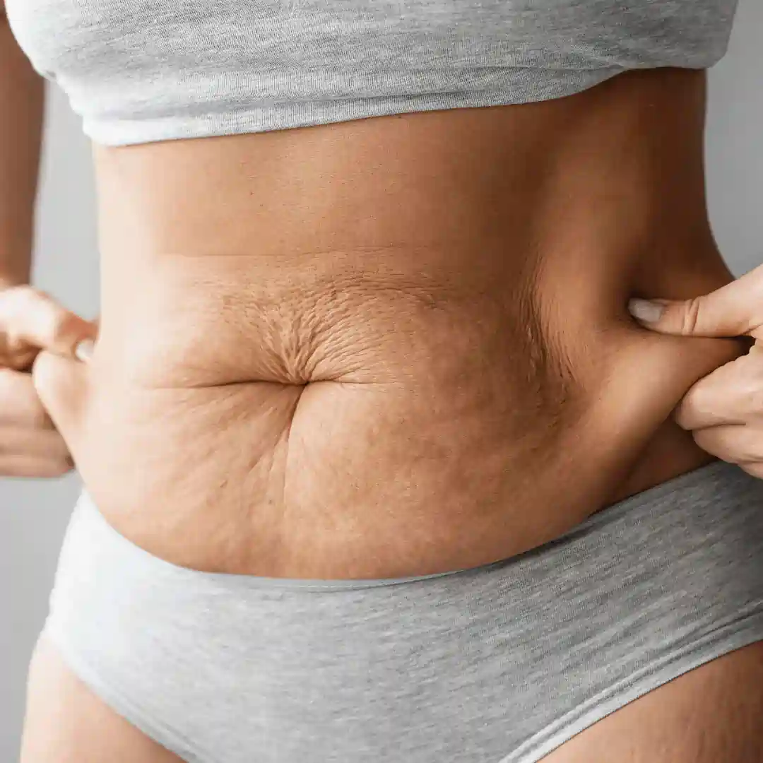 Is It Normal to Have Loose Skin After Pregnancy Billericay?