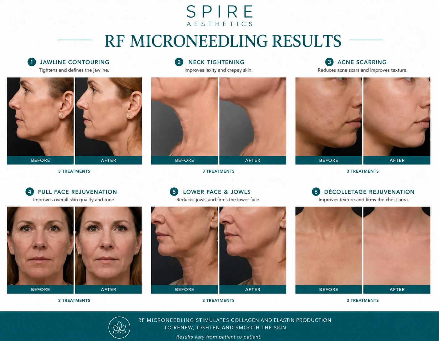 RF Microneedling Skin tightening Billericay results