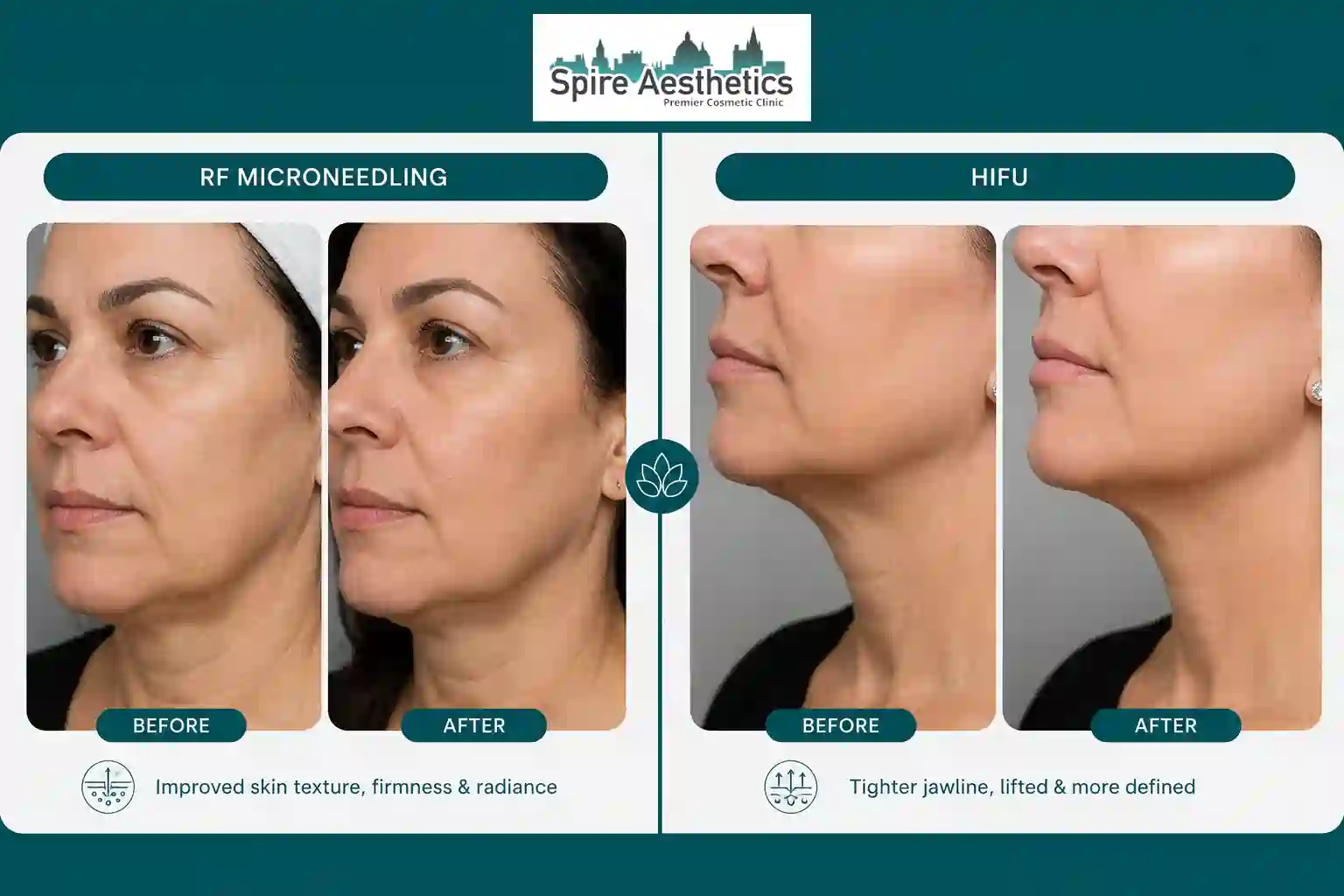 Can RF Microneedling and HIFU Be Combined Billericay?