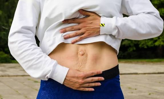 When Could Diastasis Recti Be the Missing Piece of the Puzzle Billericay?