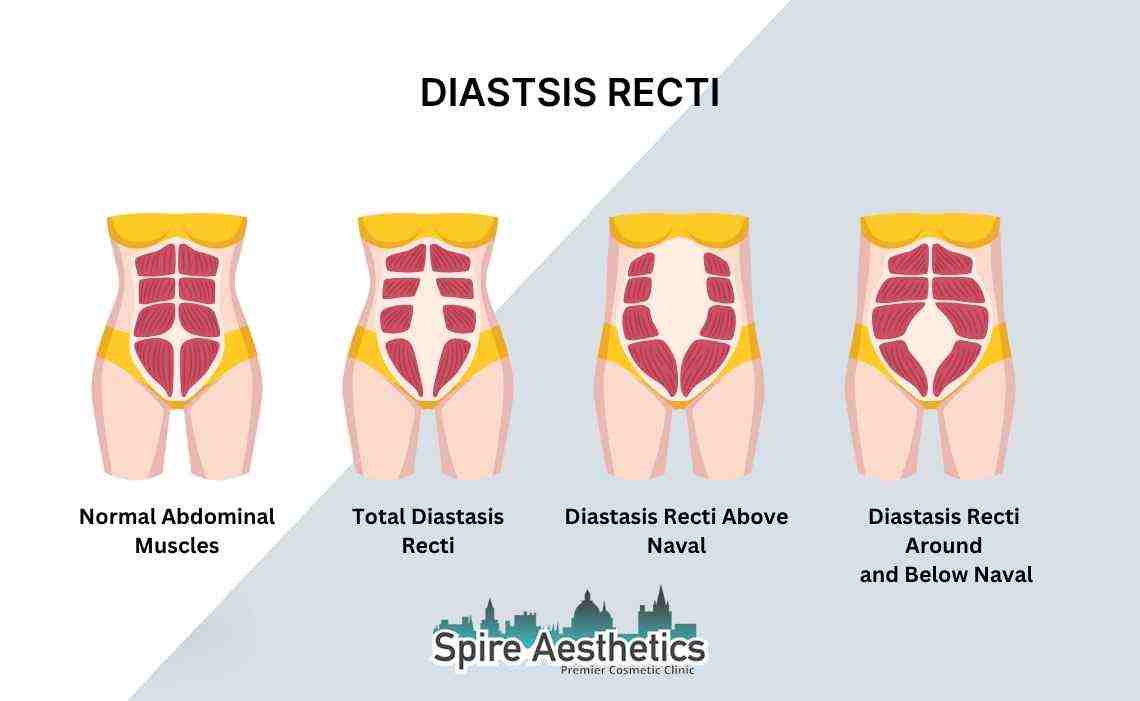 Is Non-Surgical Diastasis Recti Treatment Right for You? Common Concerns Answered Billericay